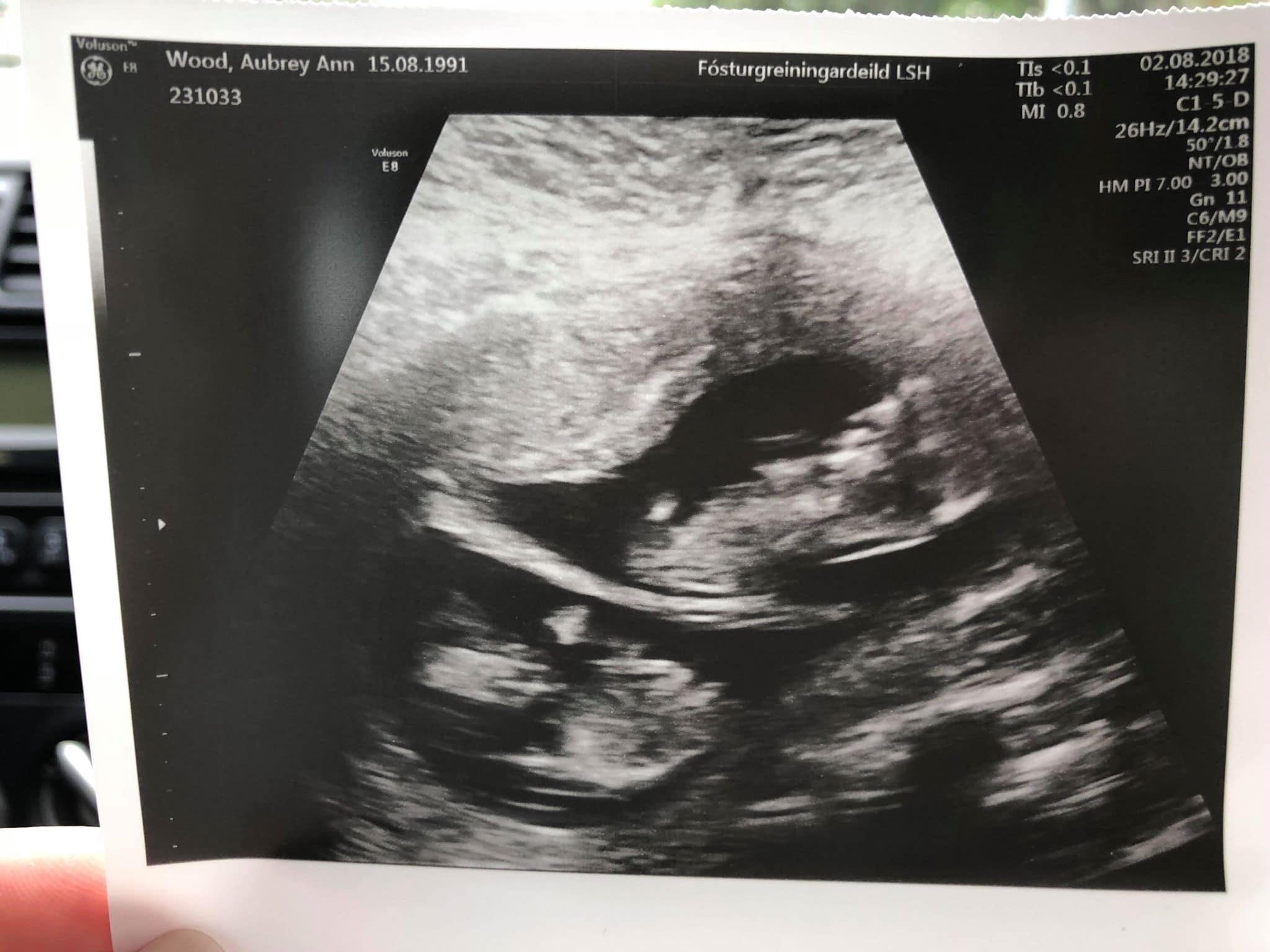 Ultrasound Photos at 12 Weeks Pregnant With Twins