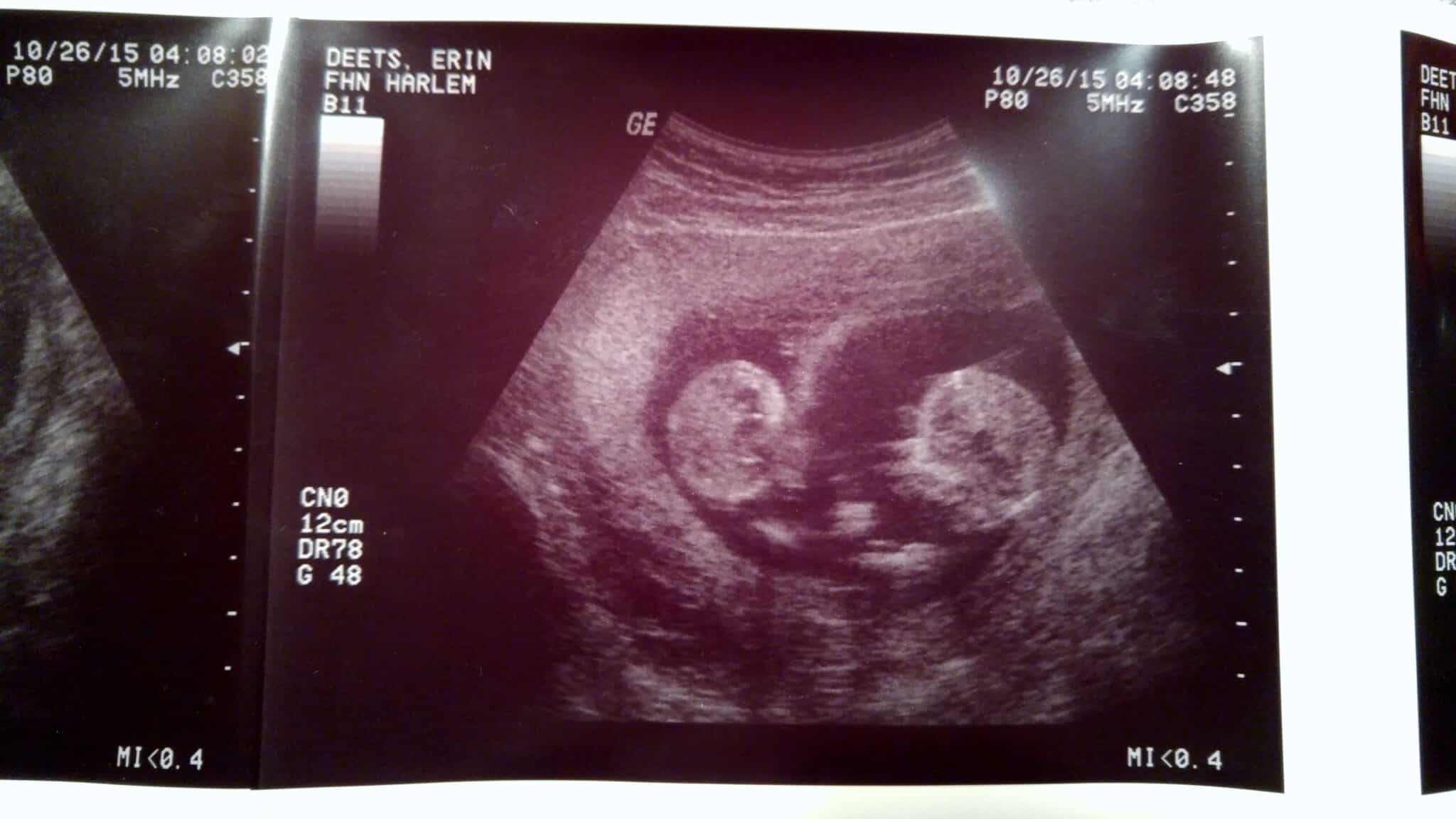 Ultrasound Photos at 12 Weeks Pregnant With Twins