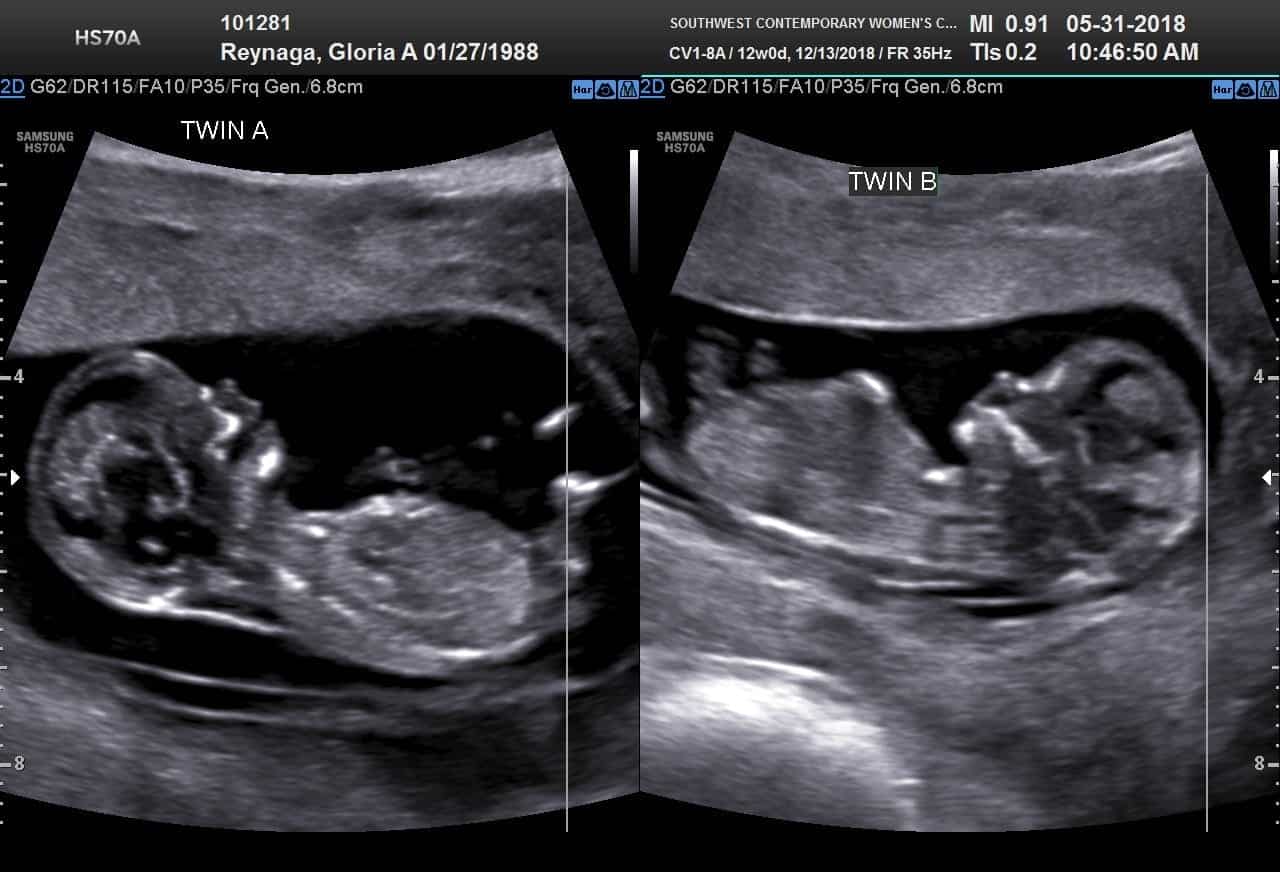 Ultrasound Photos at 12 Weeks Pregnant With Twins