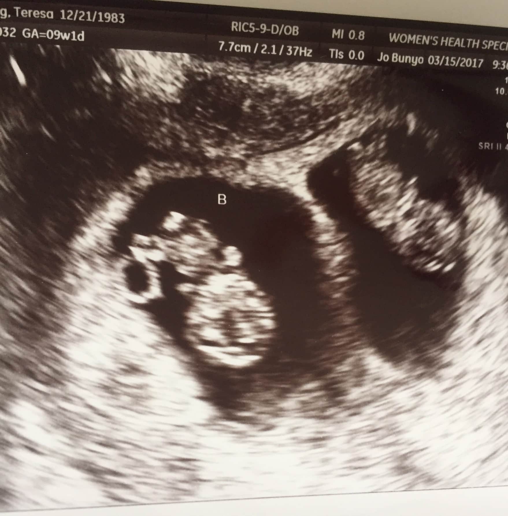 Ultrasound Photos at 12 Weeks Pregnant With Twins
