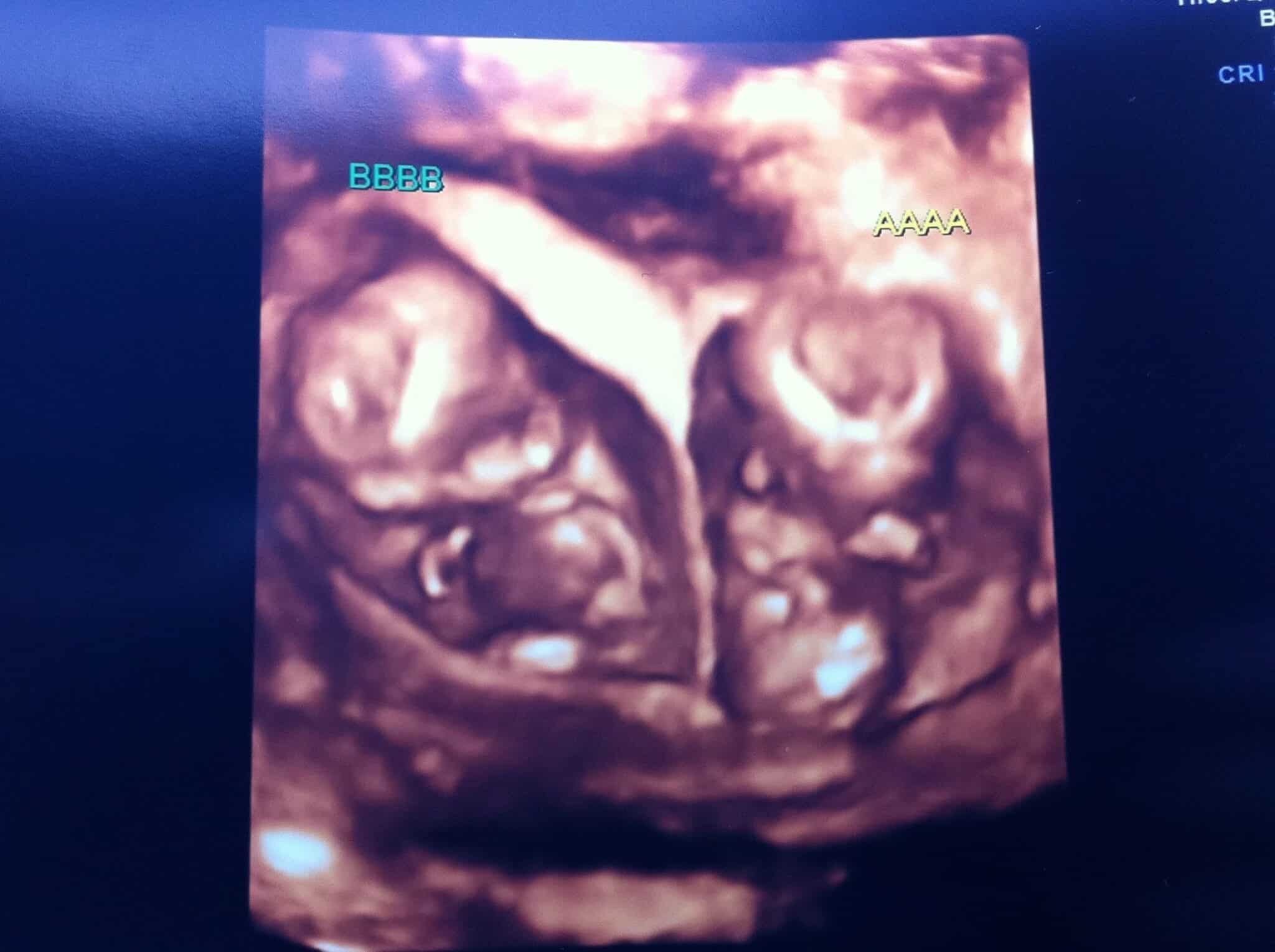 Ultrasound Photos at 12 Weeks Pregnant With Twins
