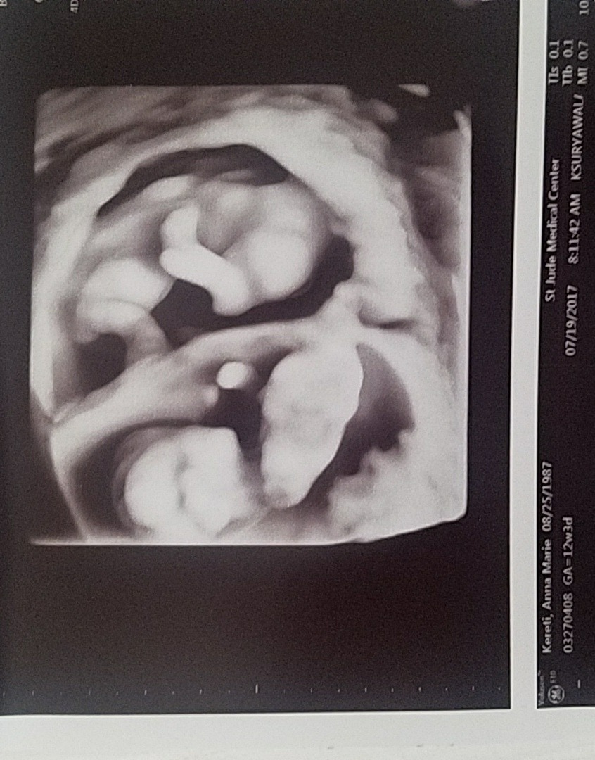 Ultrasound Photos at 12 Weeks Pregnant With Twins