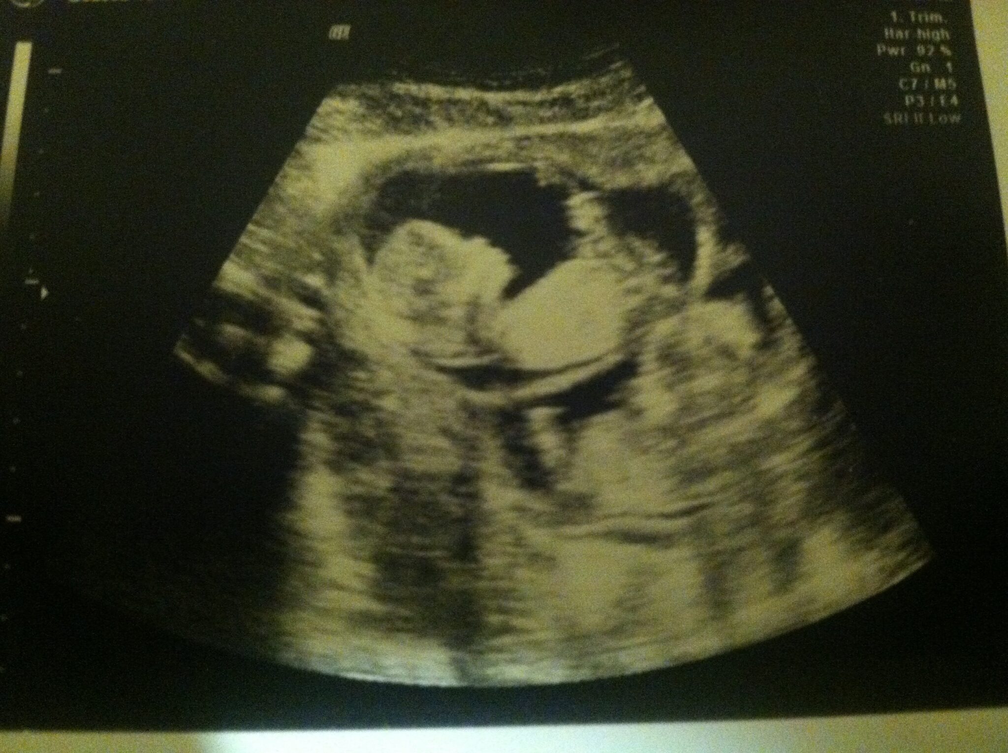 Ultrasound Photos at 12 Weeks Pregnant With Twins