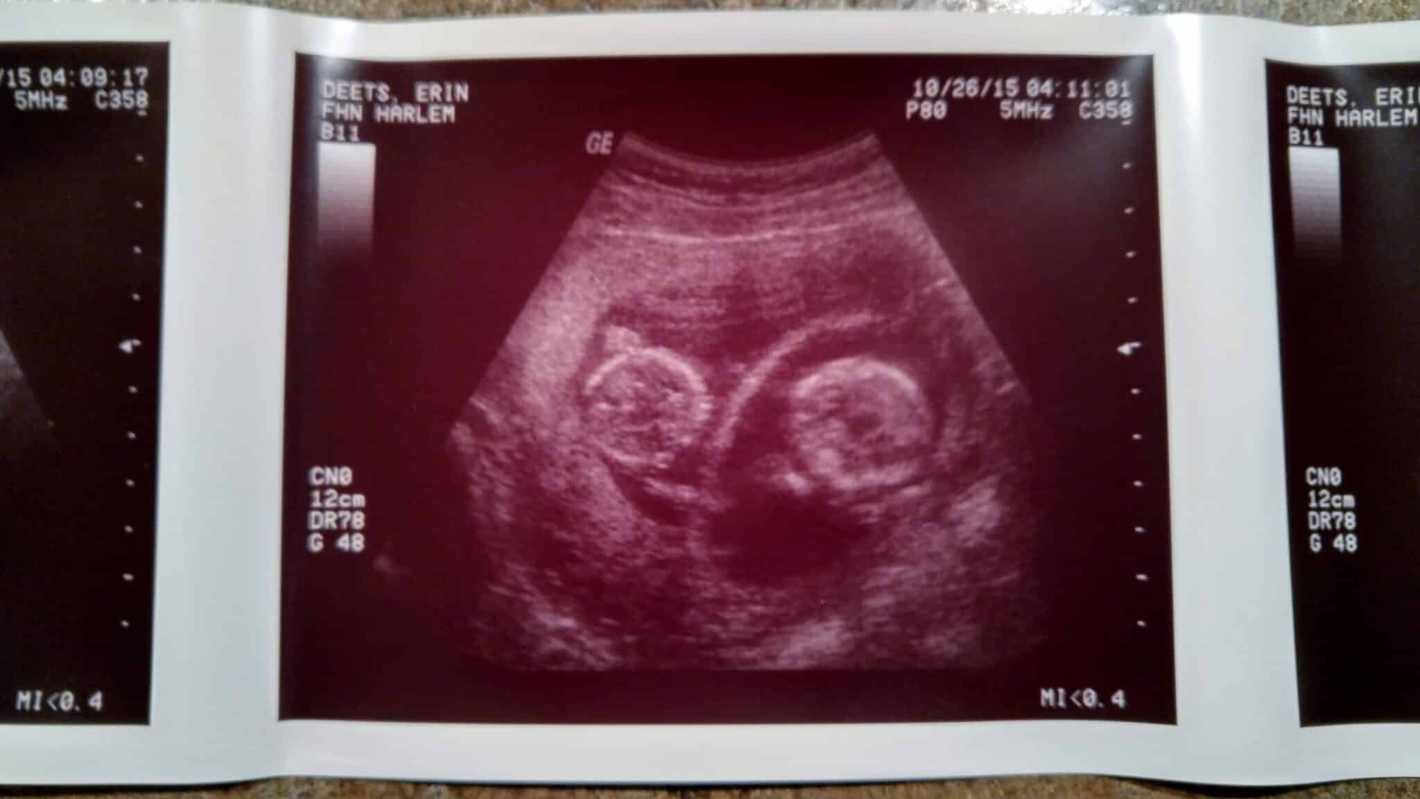 Ultrasound Photos at 12 Weeks Pregnant With Twins