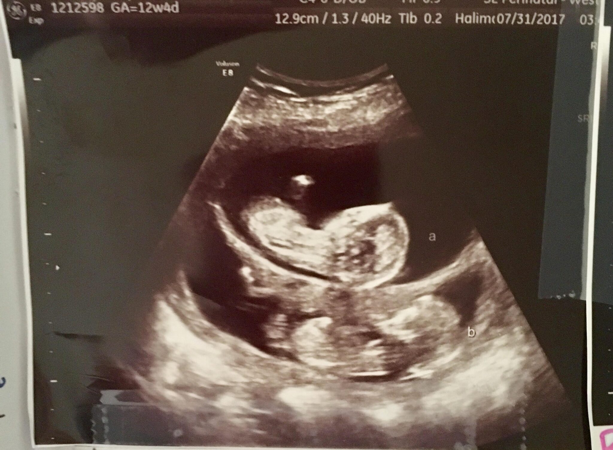 Ultrasound Photos at 12 Weeks Pregnant With Twins