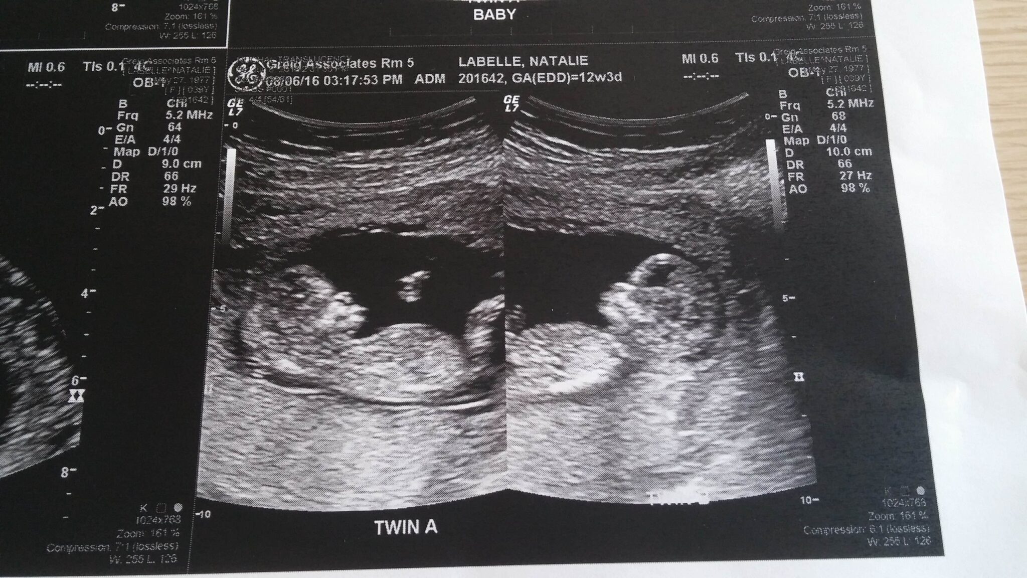 Ultrasound Photos at 12 Weeks Pregnant With Twins