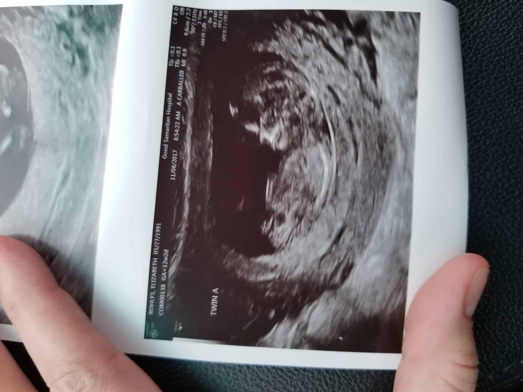 Ultrasound Photos at 12 Weeks Pregnant With Twins
