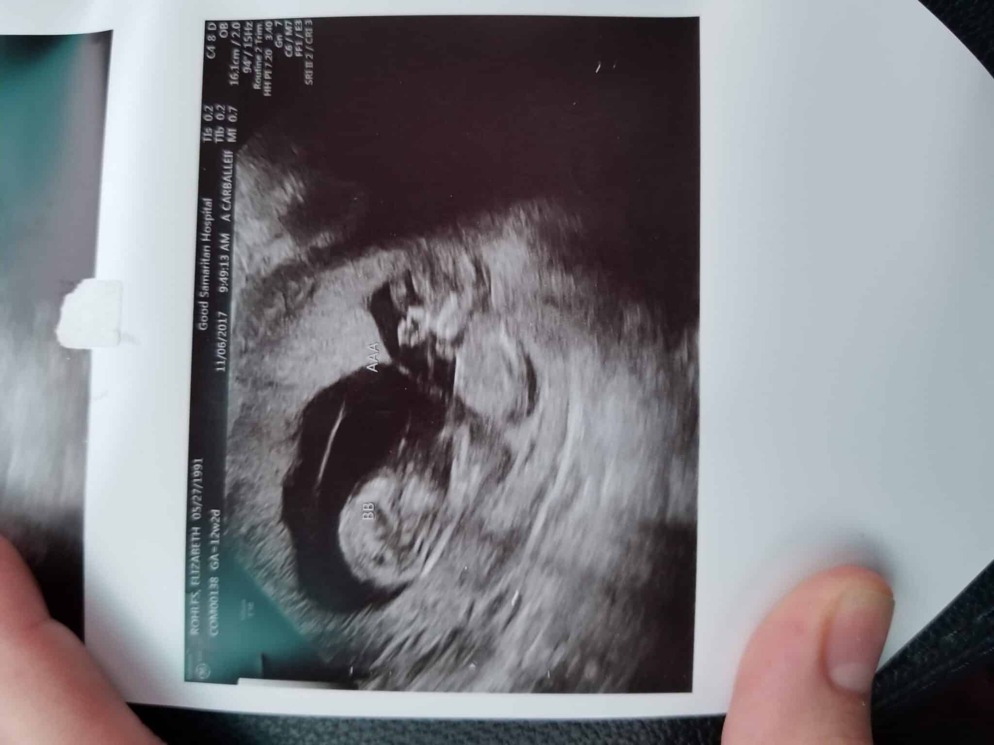 Ultrasound Photos at 12 Weeks Pregnant With Twins