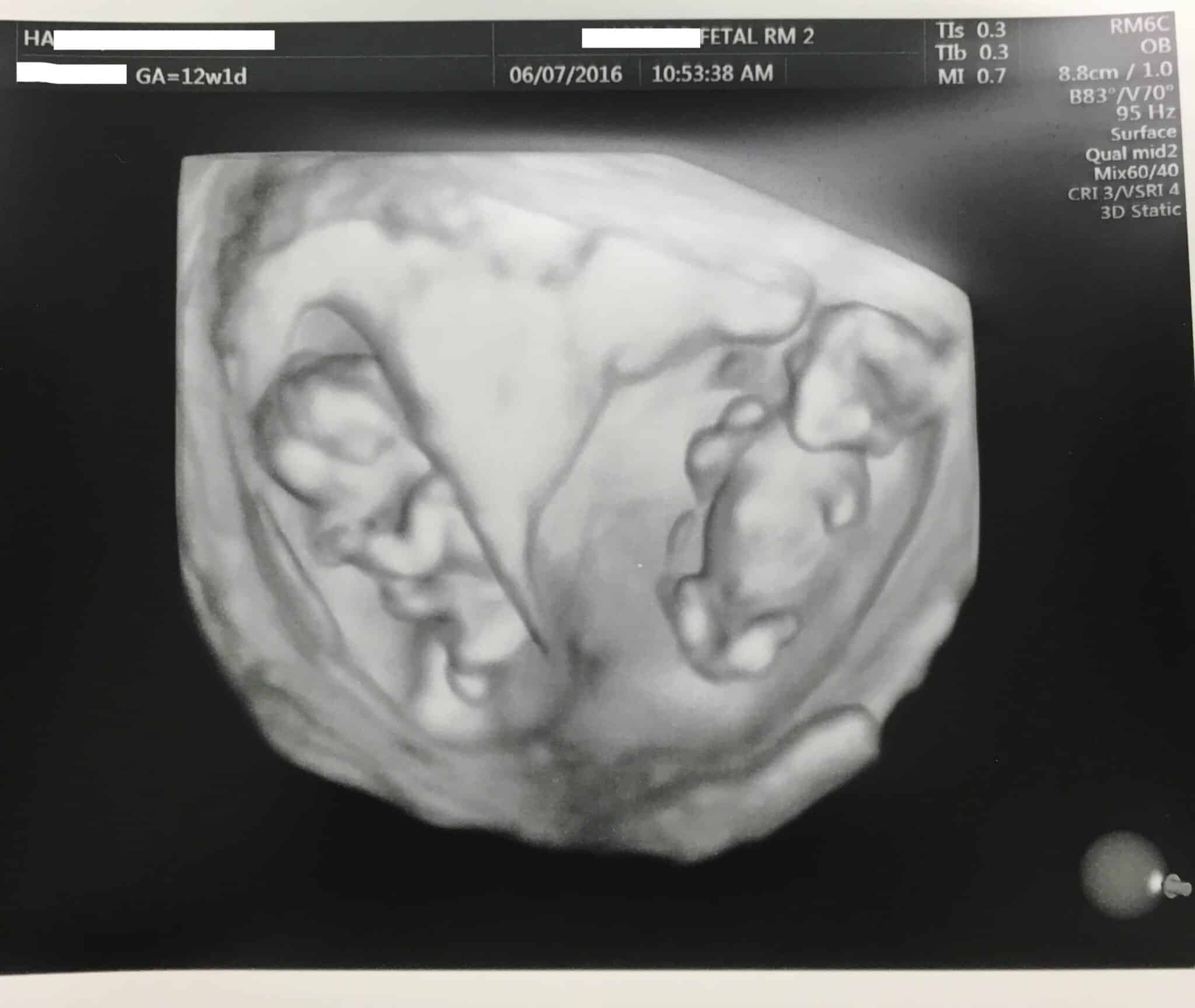 Ultrasound Photos at 12 Weeks Pregnant With Twins