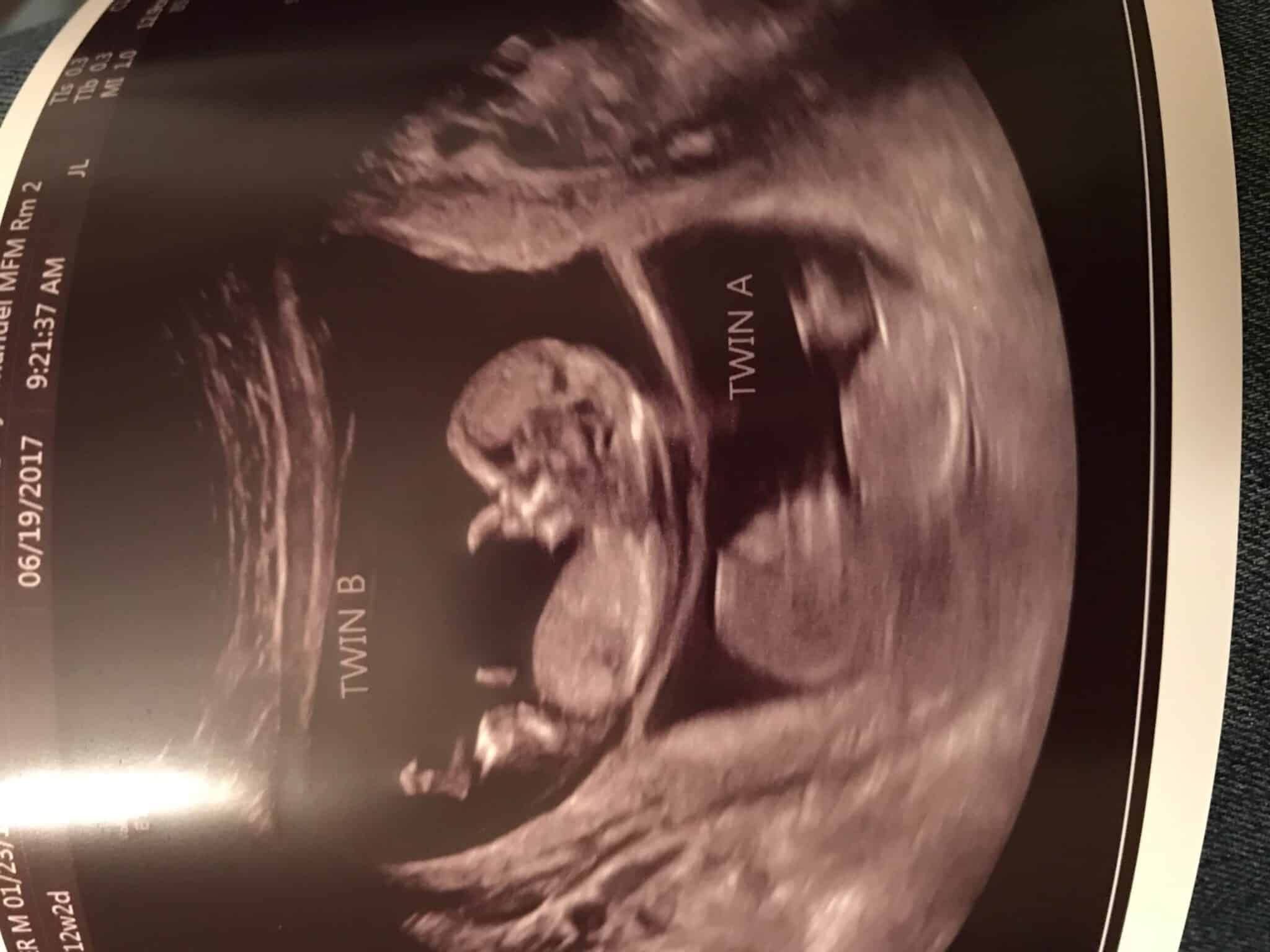 Ultrasound Photos at 12 Weeks Pregnant With Twins