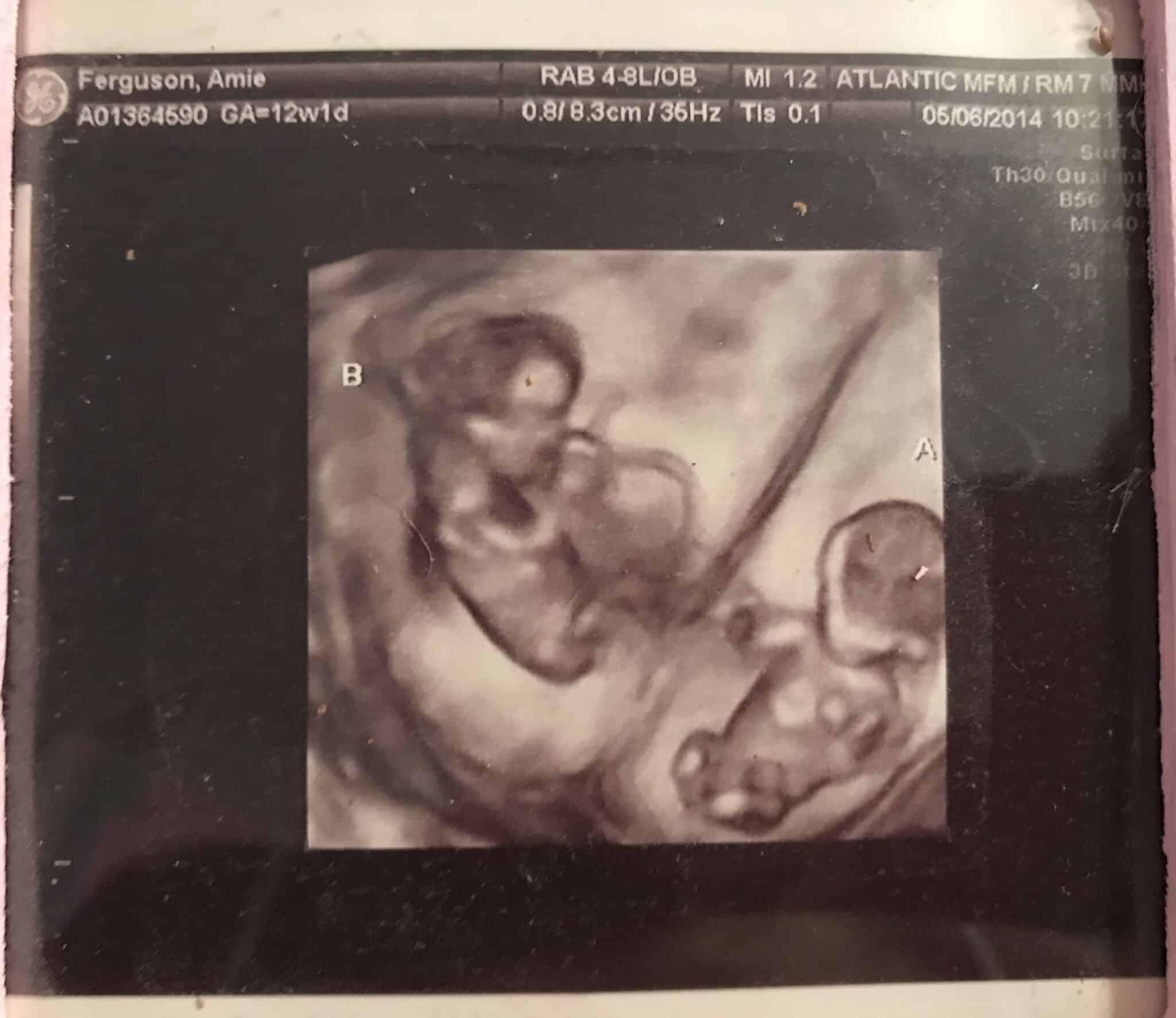 Ultrasound Photos at 12 Weeks Pregnant With Twins