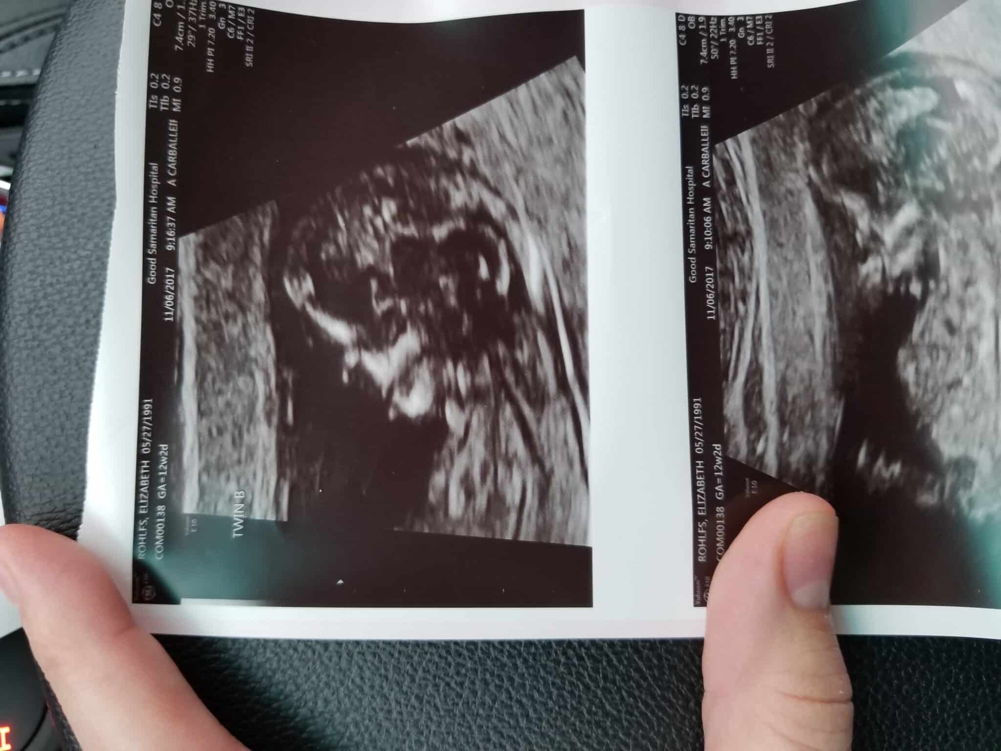 Ultrasound Photos at 12 Weeks Pregnant With Twins