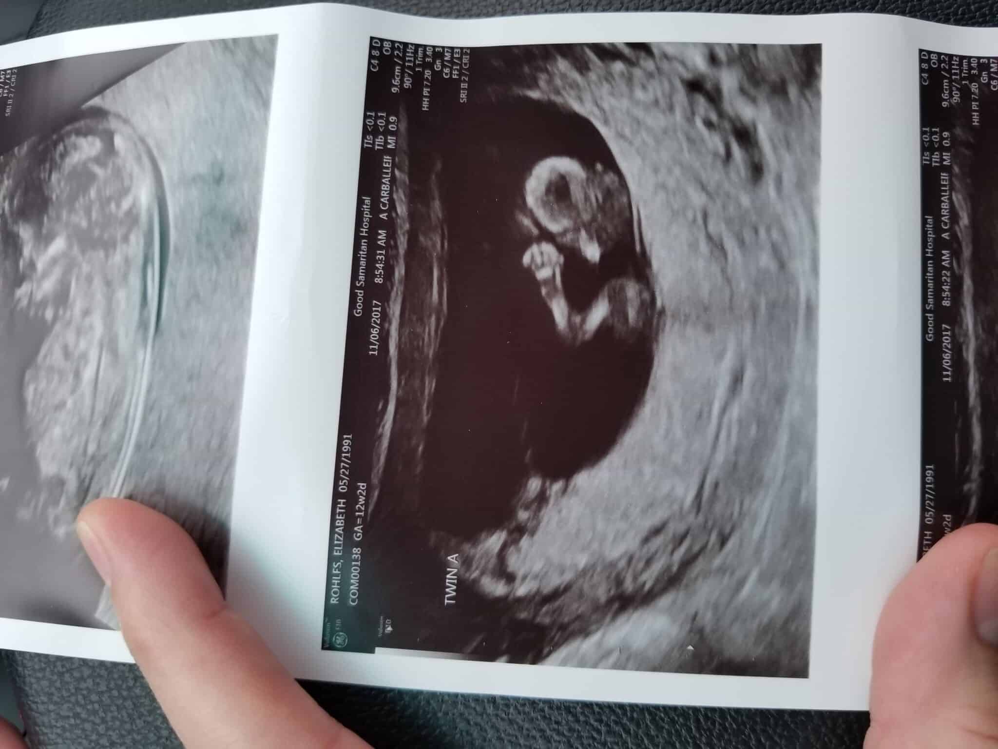 Ultrasound Photos at 12 Weeks Pregnant With Twins