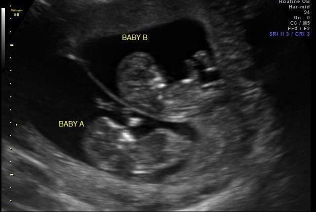 Ultrasound Photos at 12 Weeks Pregnant With Twins
