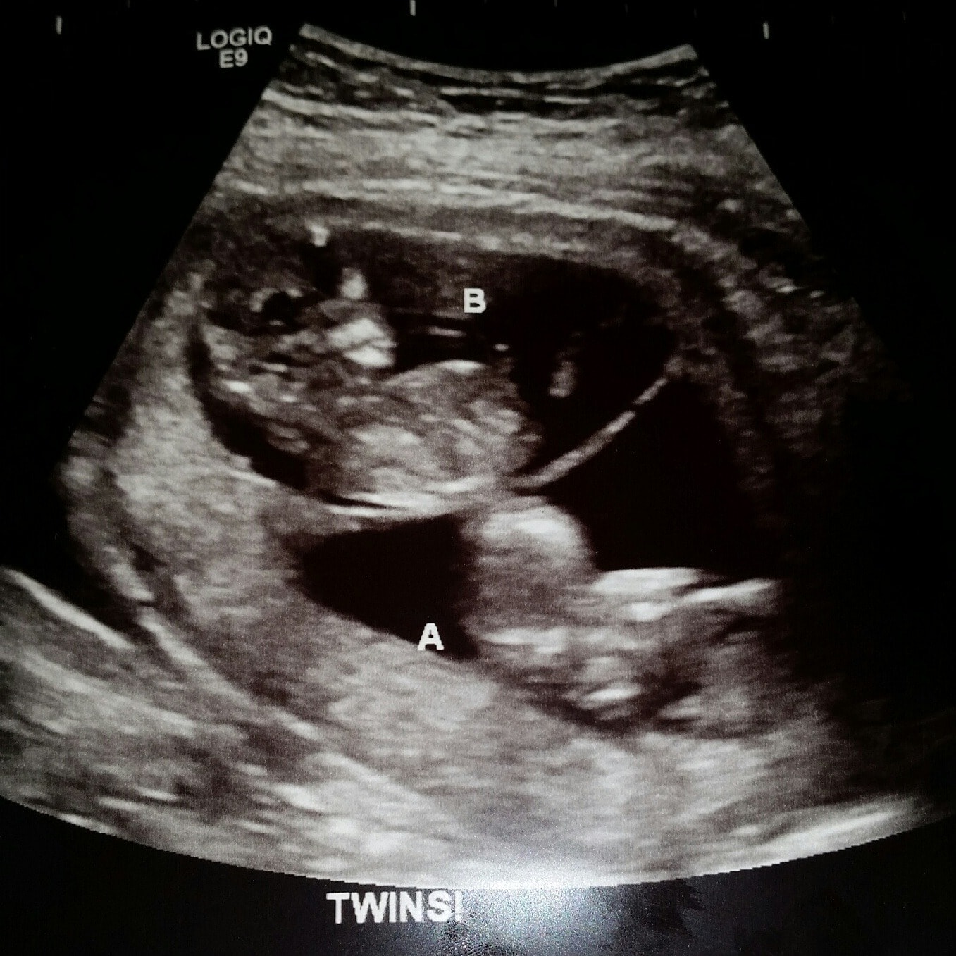 Ultrasound Photos at 12 Weeks Pregnant With Twins