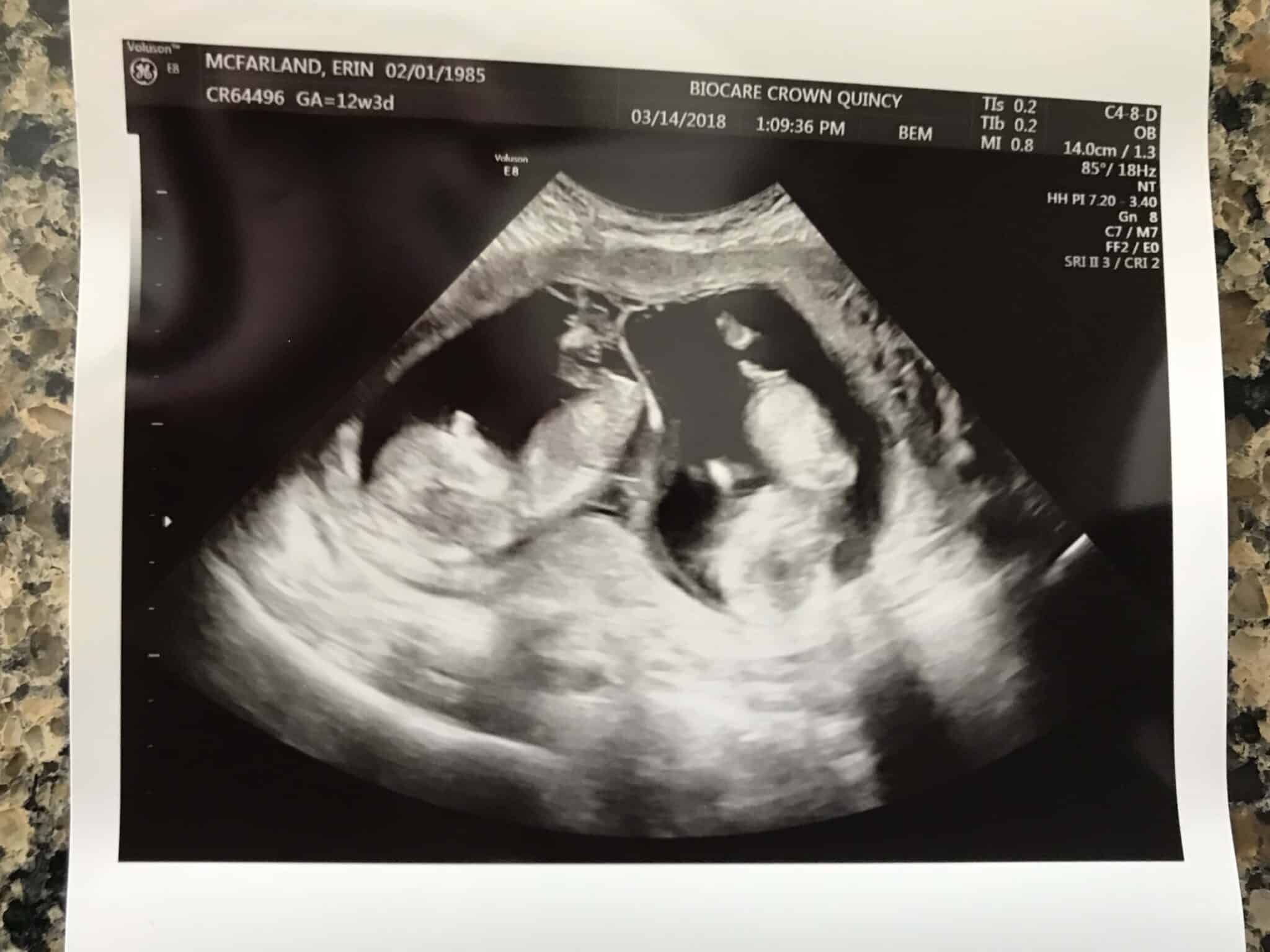 Ultrasound Photos at 12 Weeks Pregnant With Twins