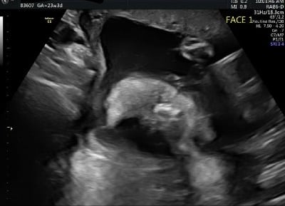 23 Weeks Pregnant With Twins Ultrasound
