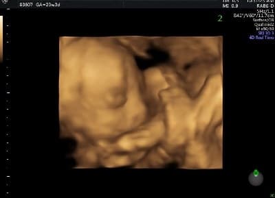 23 Weeks Pregnant With Twins Ultrasound