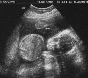 23 Weeks Pregnant With Twins Ultrasound
