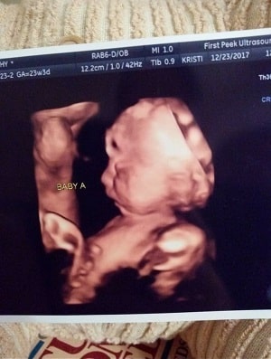 23 Weeks Pregnant With Twins Ultrasound