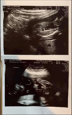 23 Weeks Pregnant With Twins Ultrasound