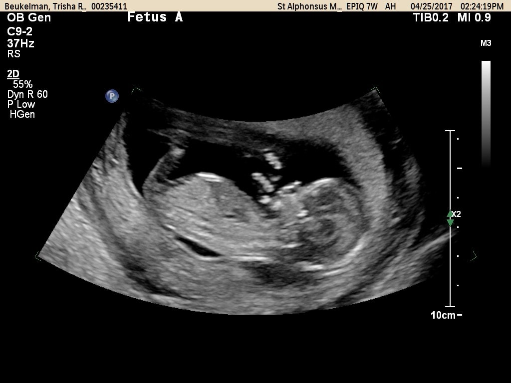 13 weeks pregnant with twins