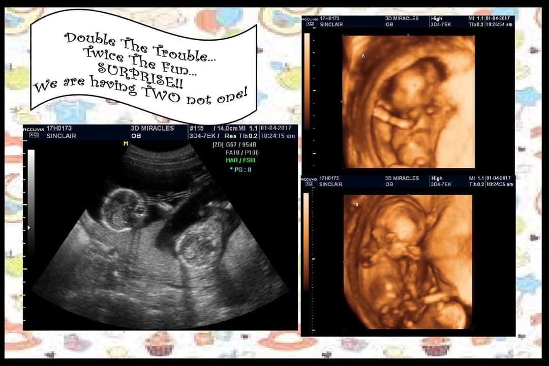 15 weeks pregnant with twins