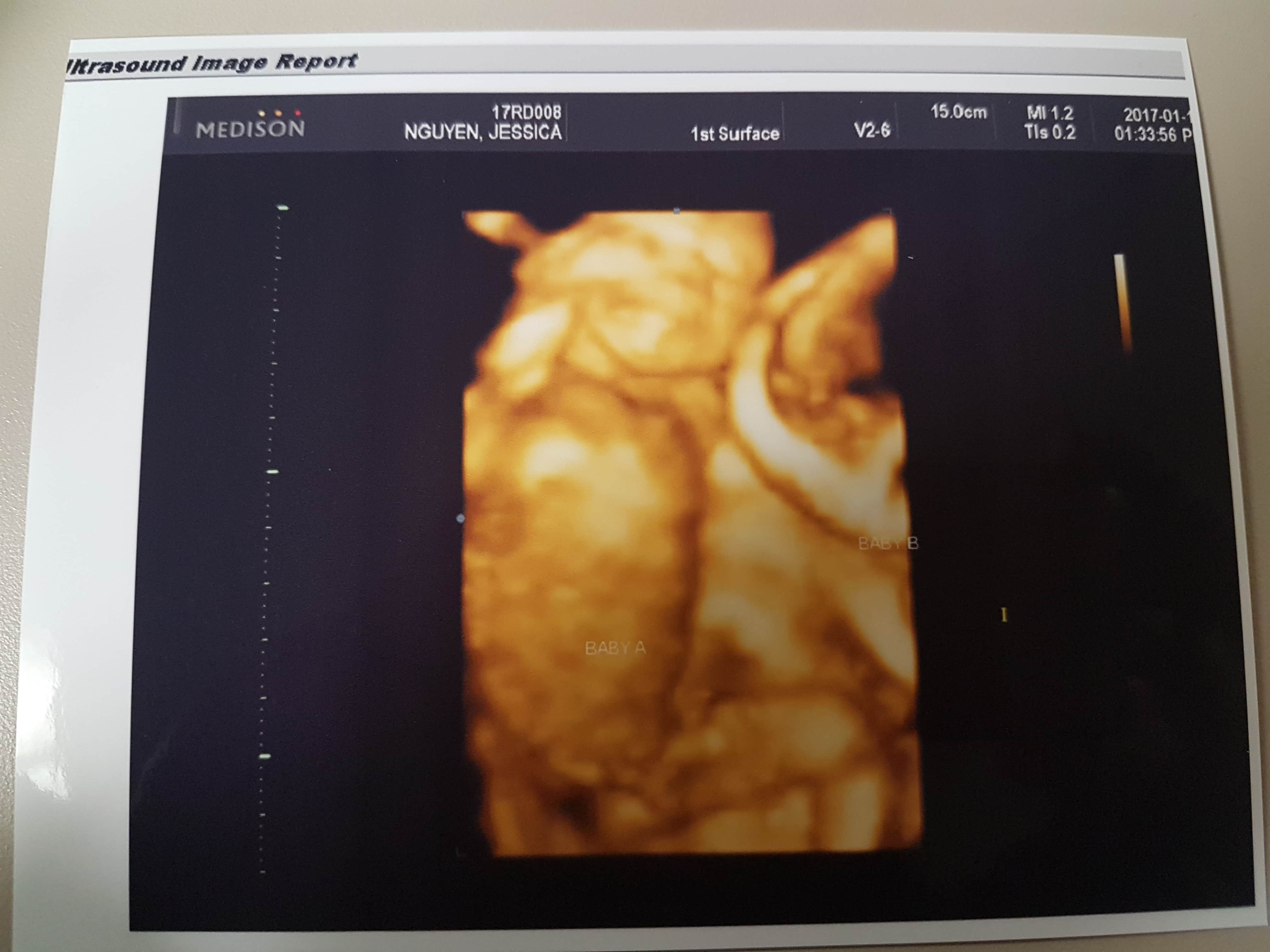 18 weeks pregnant with twins