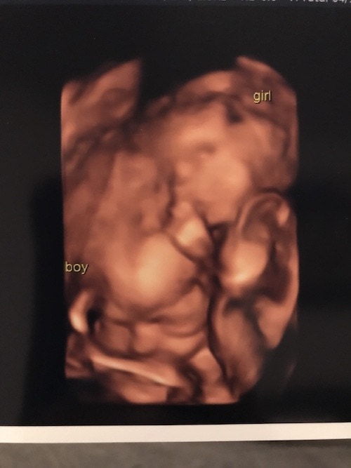 24 weeks pregnant with twins