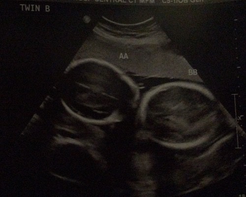 25 weeks pregnant with twins