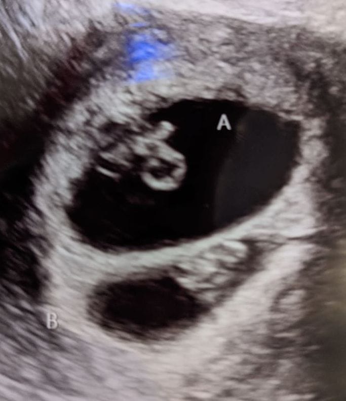Twin Ultrasound at 7 Weeks