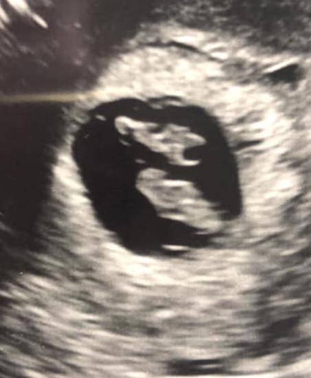 Twin Ultrasound at 7 Weeks