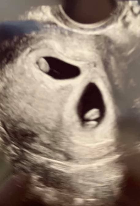 Twin Ultrasound at 7 Weeks