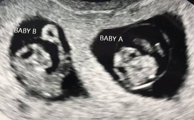 Twin Ultrasound at 7 Weeks