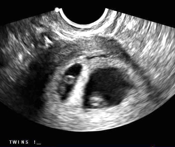 Twin Ultrasound at 7 Weeks