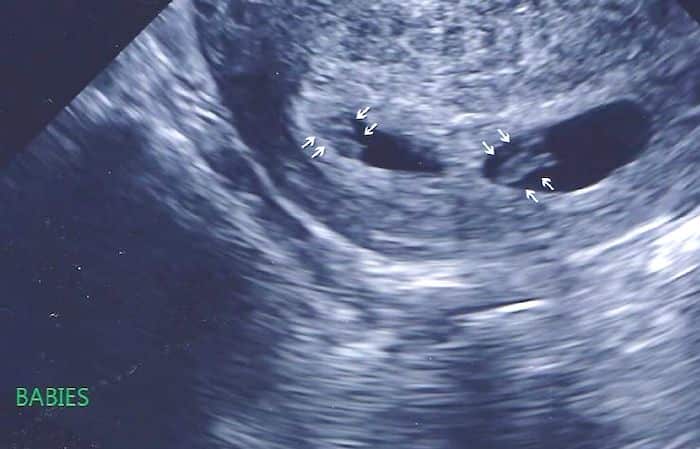 Twin Ultrasound at 7 Weeks