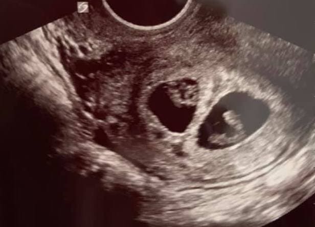Twin Ultrasound at 7 Weeks