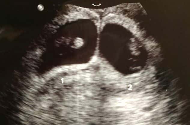 Twin Ultrasound at 7 Weeks