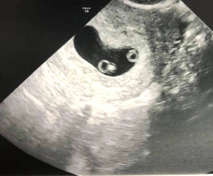 Twin Ultrasound at 7 Weeks