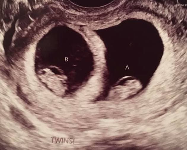 Twin Ultrasound at 7 Weeks