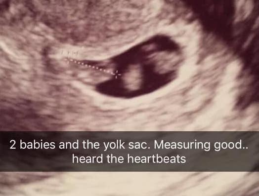 Twin Ultrasound at 7 Weeks