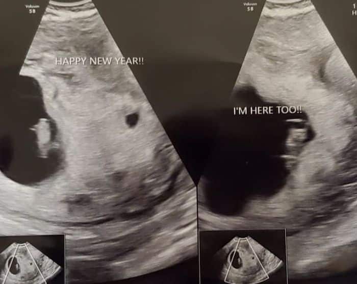 Twin Ultrasound at 7 Weeks