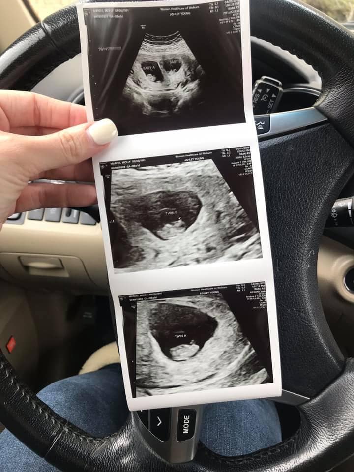 Twin Ultrasound at 7 Weeks
