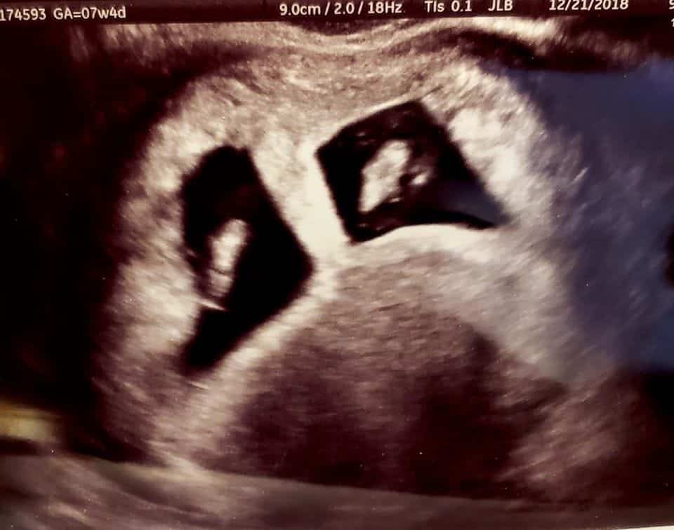 Twin Ultrasound at 7 Weeks