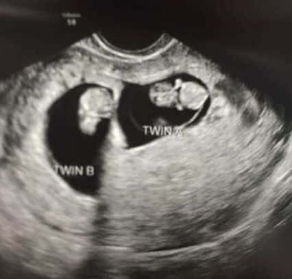Twin Ultrasound at 7 Weeks