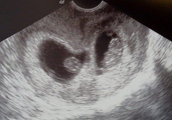 8 Week Sonogram
