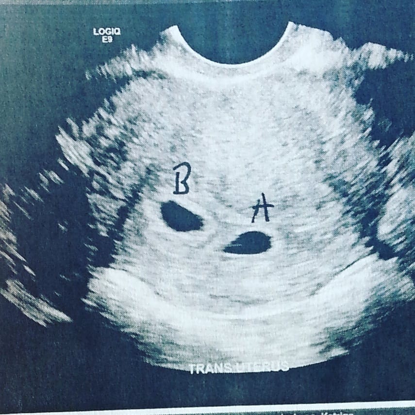 8 Week Sonogram
