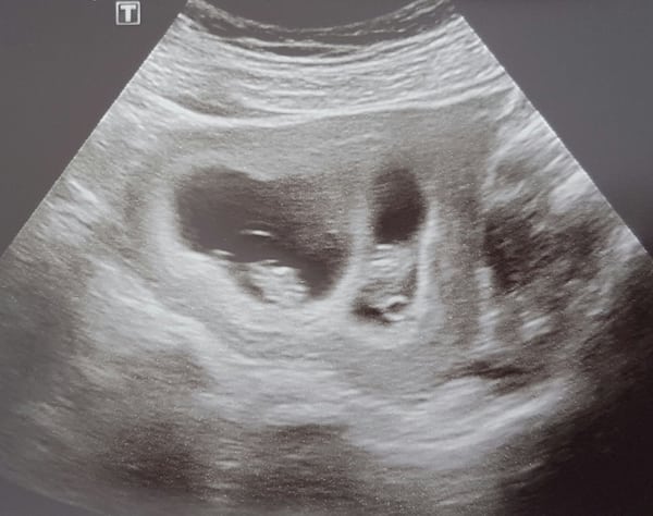 8 Week Sonogram