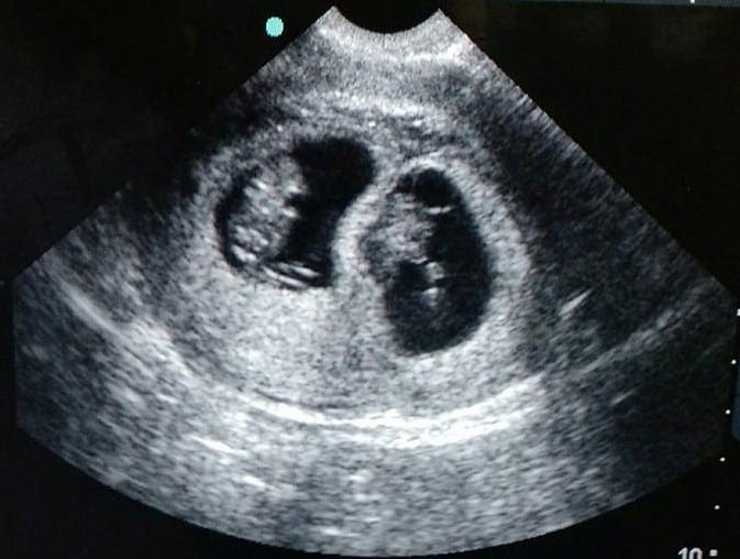 8 Week Twin Ultrasound