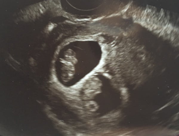 8 Week Sonogram